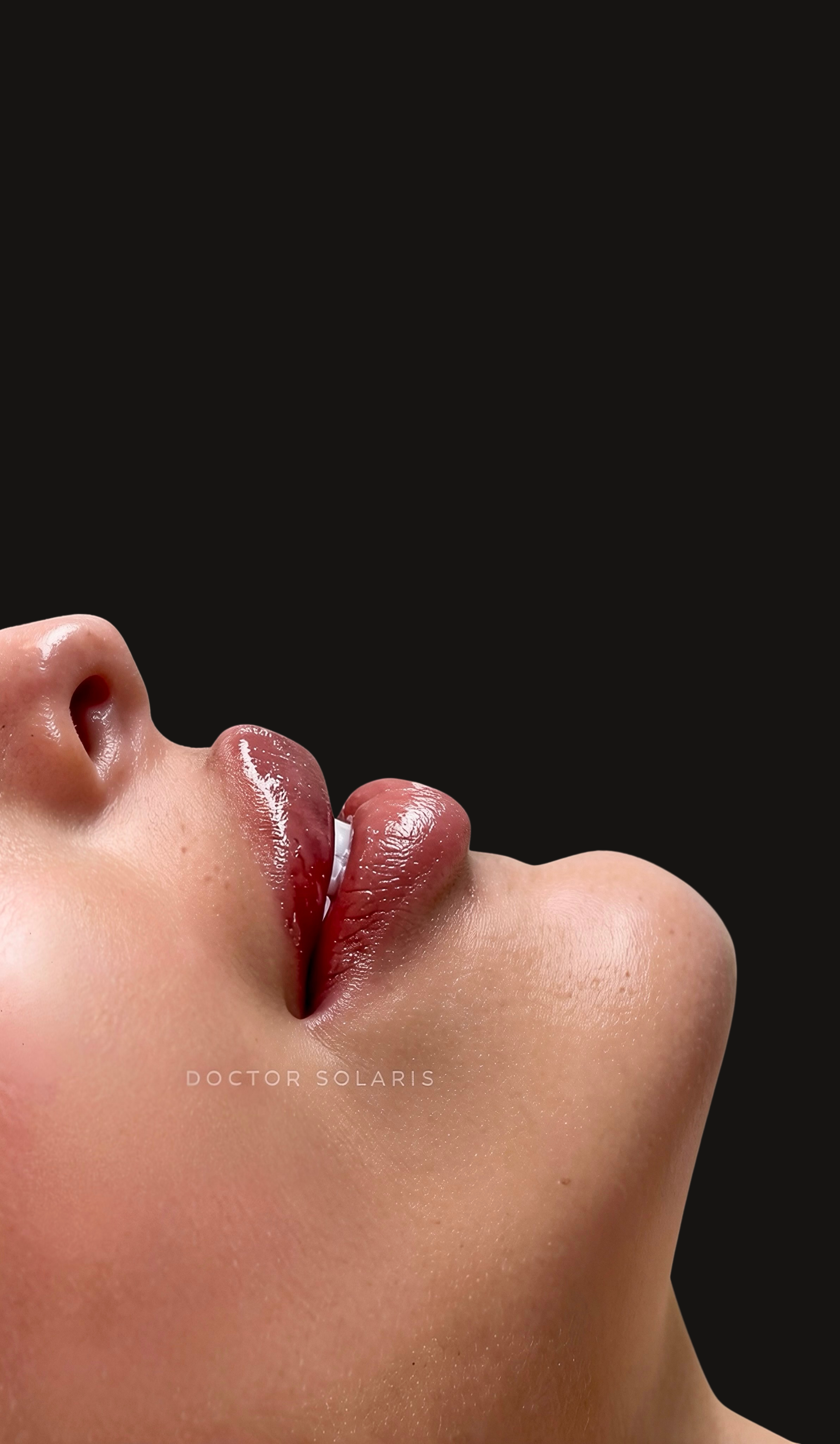 Fillers resultaat