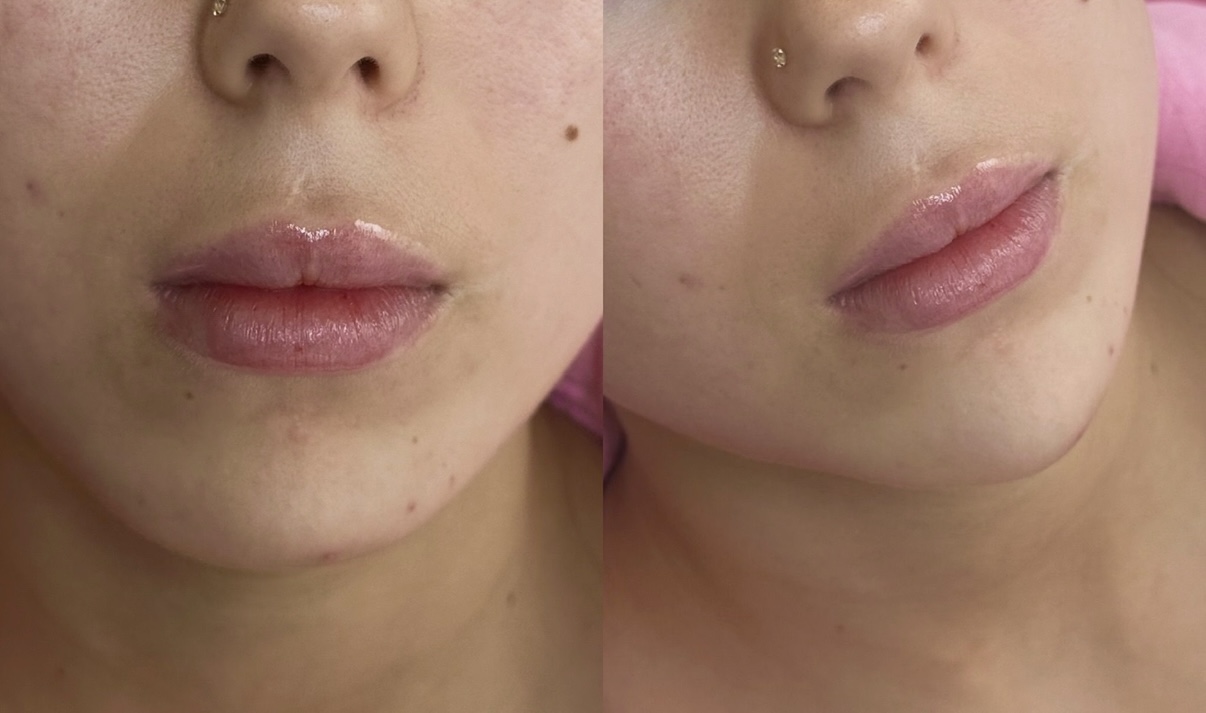 Filler Packages