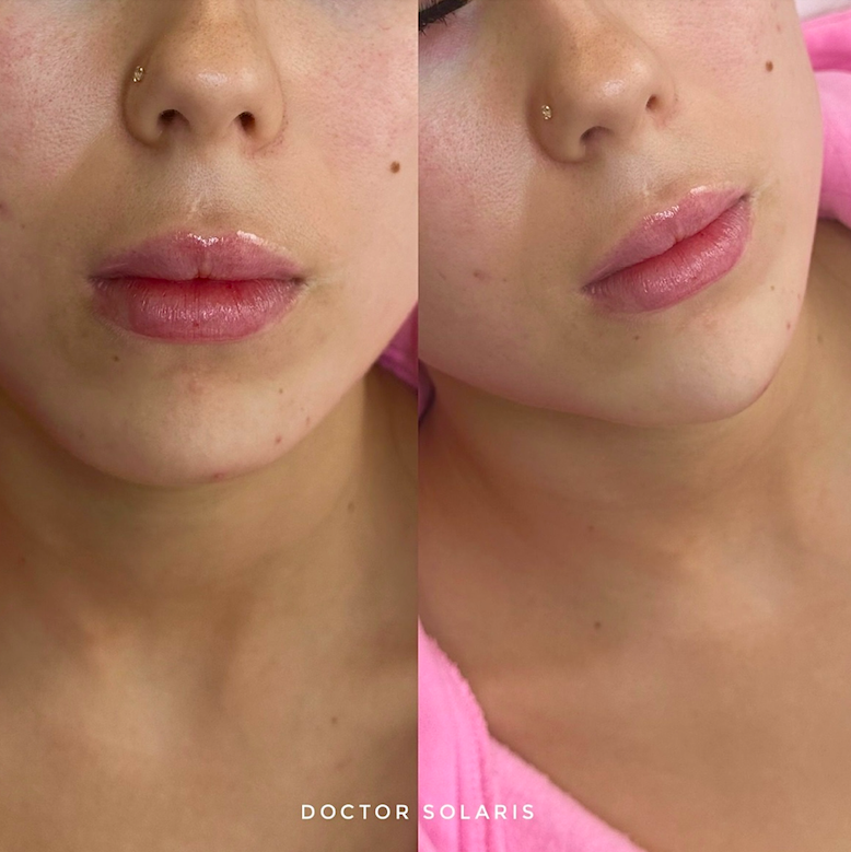Filler packages resultaat