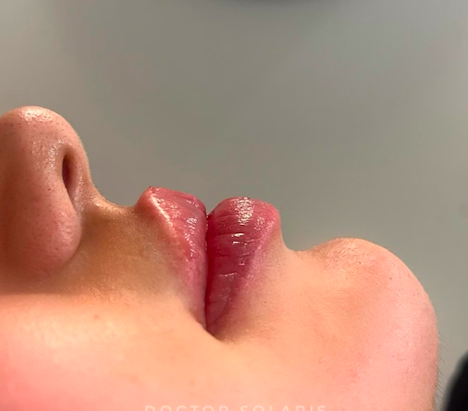 Fillers behandeling